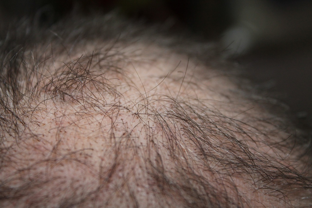 Welche Krankheiten verursachen Haarausfall?